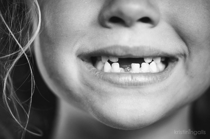 Τι να κάνετε αν το παιδί σας σπάσει το δόντι του στις&nbsp;διακοπές