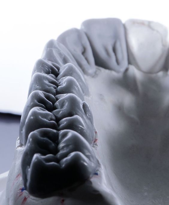 Γιατί είναι σημαντική η έγκαιρη αποκατάσταση ενός χαμένου&nbsp;δοντιού;